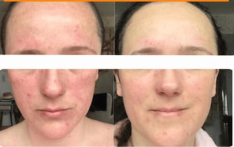 Inflamações quase eliminadas