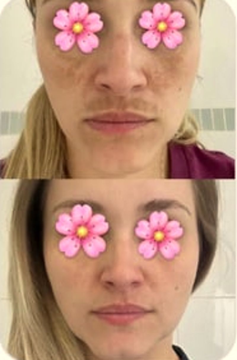 Melasma 80% mais claro