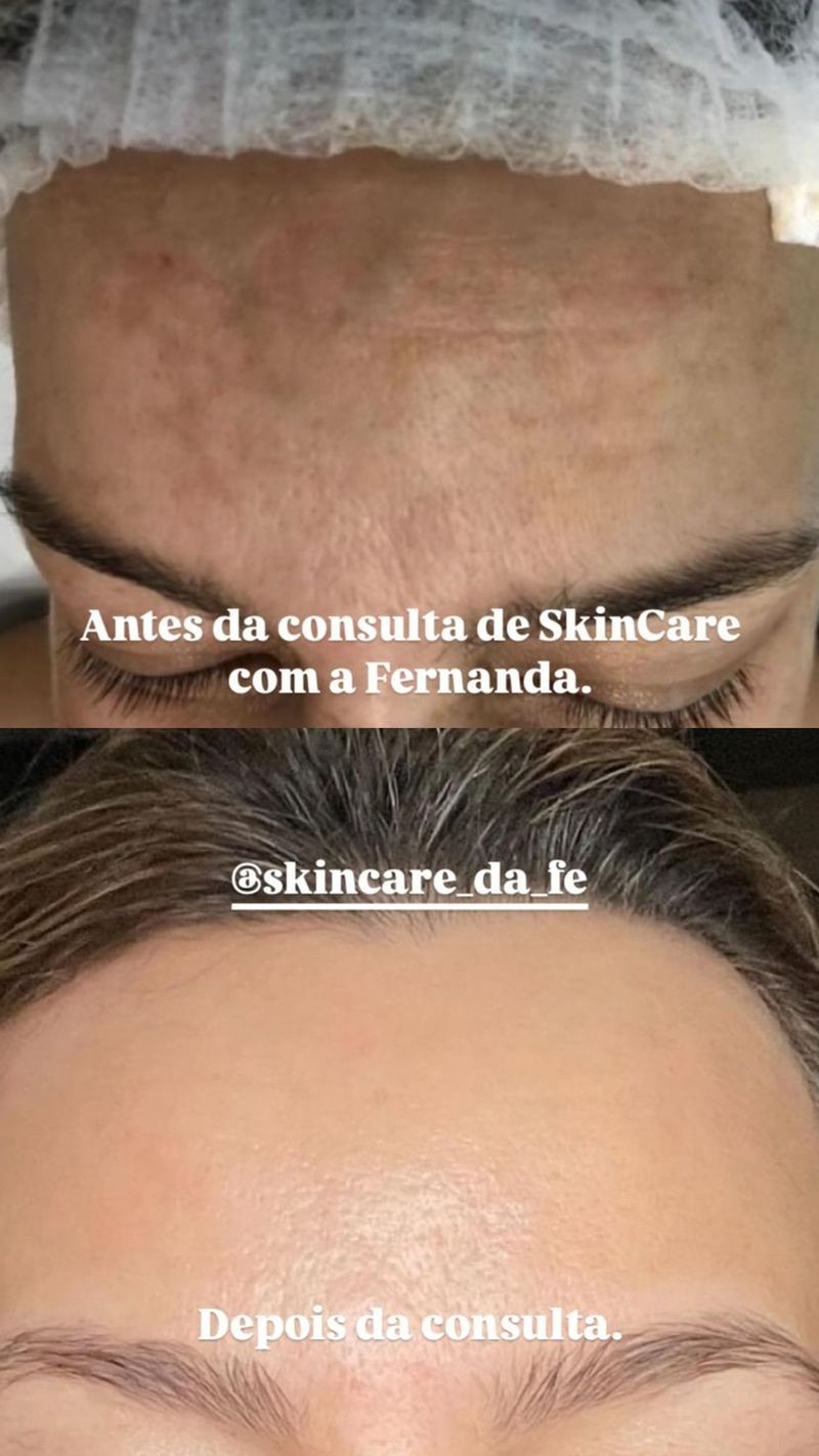 Melasma quase eliminado